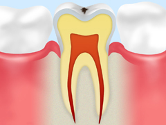 CO 【ごく初期の虫歯】