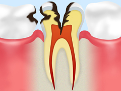 C2 【象牙質の虫歯】