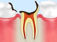 C3 【神経に達した虫歯】