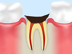 C4 【歯根に達した虫歯】